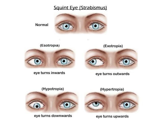 EYE DISORDERS IN CHILDREN AND SQUINT SURGERY